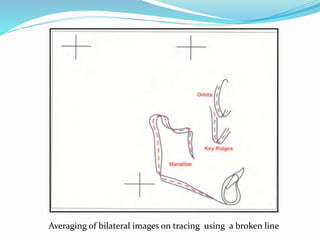 Averaging of bilateral images on tracing using a broken line
 