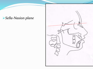 Sella-Nasion plane
S N
 