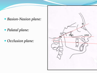  Basion-Nasion plane:
 Palatal plane:
 Occlusion plane:
Ba
N
ANSPNS
 