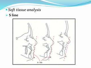  Soft tissue analysis
 S line
 
