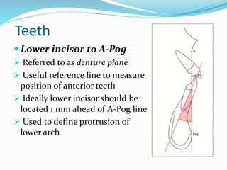 Teeth
 Lower incisor to A-Pog
 Referred to as denture plane
 Useful reference line to measure
position of anterior teeth
 Ideally lower incisor should be
located 1 mm ahead of A-Pog line
 Used to define protrusion of
lower arch
 