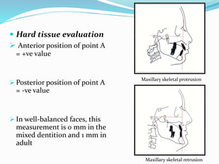  Hard tissue evaluation
 Anterior position of point A
= +ve value
 Posterior position of point A
= -ve value
 In well-balanced faces, this
measurement is 0 mm in the
mixed dentition and 1 mm in
adult
Maxillary skeletal protrusion
Maxillary skeletal retrusion
 
