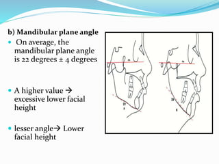 b) Mandibular plane angle
 On average, the
mandibular plane angle
is 22 degrees ± 4 degrees
 A higher value 
excessive lower facial
height
 lesser angle Lower
facial height
 