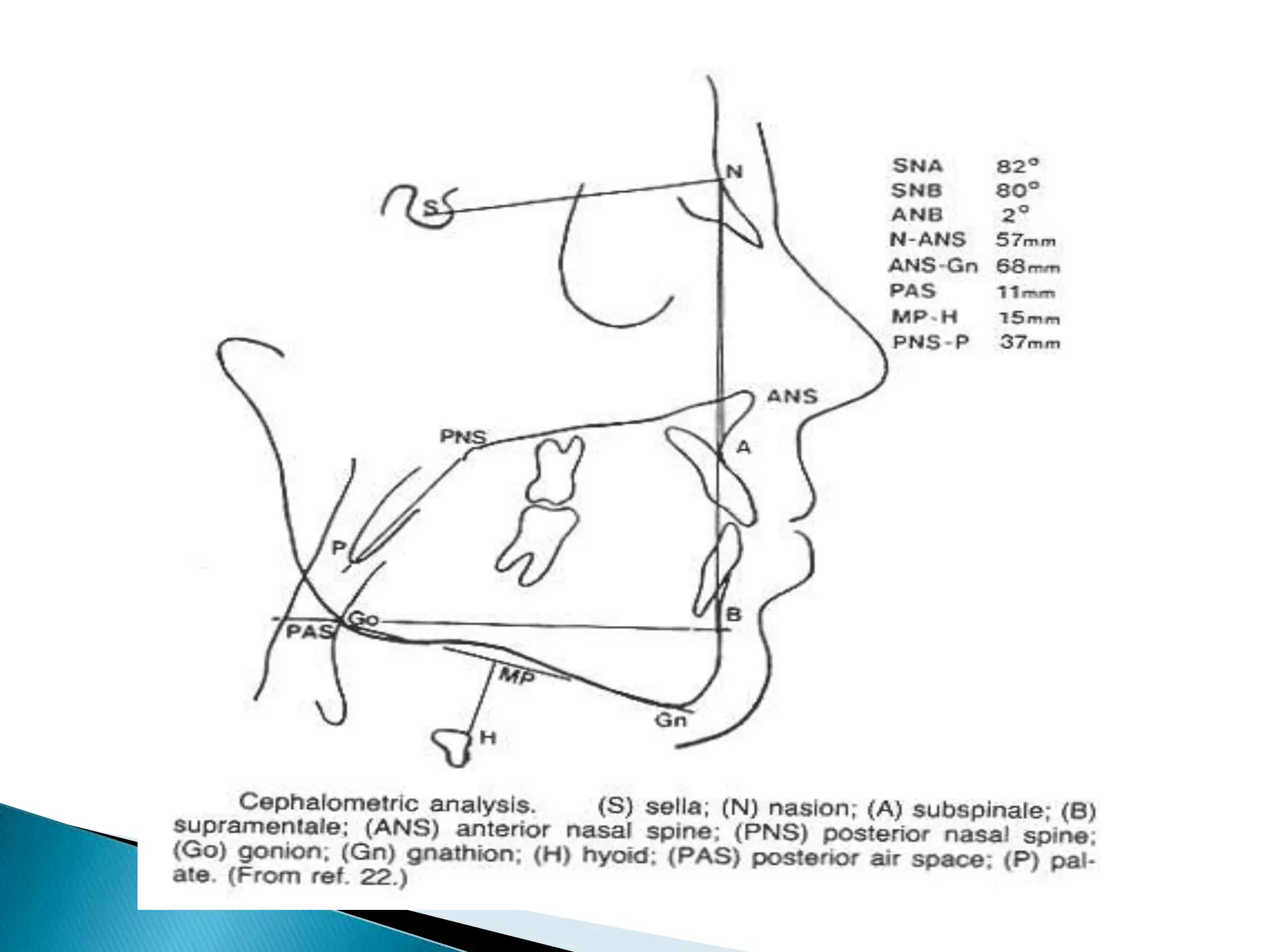 A-B plane angle;    point A – point B to nasion – pogonion.    Average value; -4.6’ ( -9 to 0’)    Significance; indicative of maxillo mandibular relationship in relation to facial plane.    Negative since point B is positioned behind point A.    Positive in class III malocclusion.