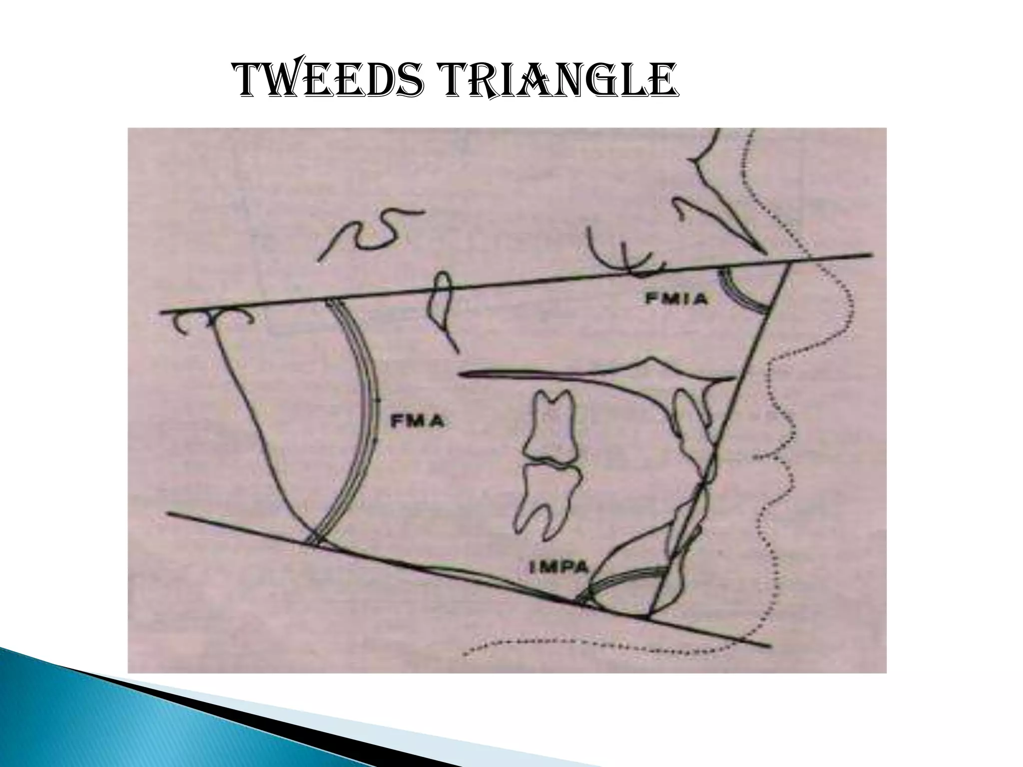 Cant of occlusal plane;    OCCLUSAL PLANE TO F.H. Plane    Average value; 9.3 ( 1.5 to 14’)    Gives a measure of slope of occlusal plane  relative to F.H. Plane.Inter incisal angle;    Angle between long axes of upper and lower incisors.    Average value: 135.4’ ( 130 to 150.5’)    increased in class I bimaxillary protrusion.DENTAL PARAMETERS