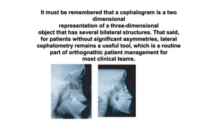 Cephalometrics for orthognathic surgery part 2 | PPTX