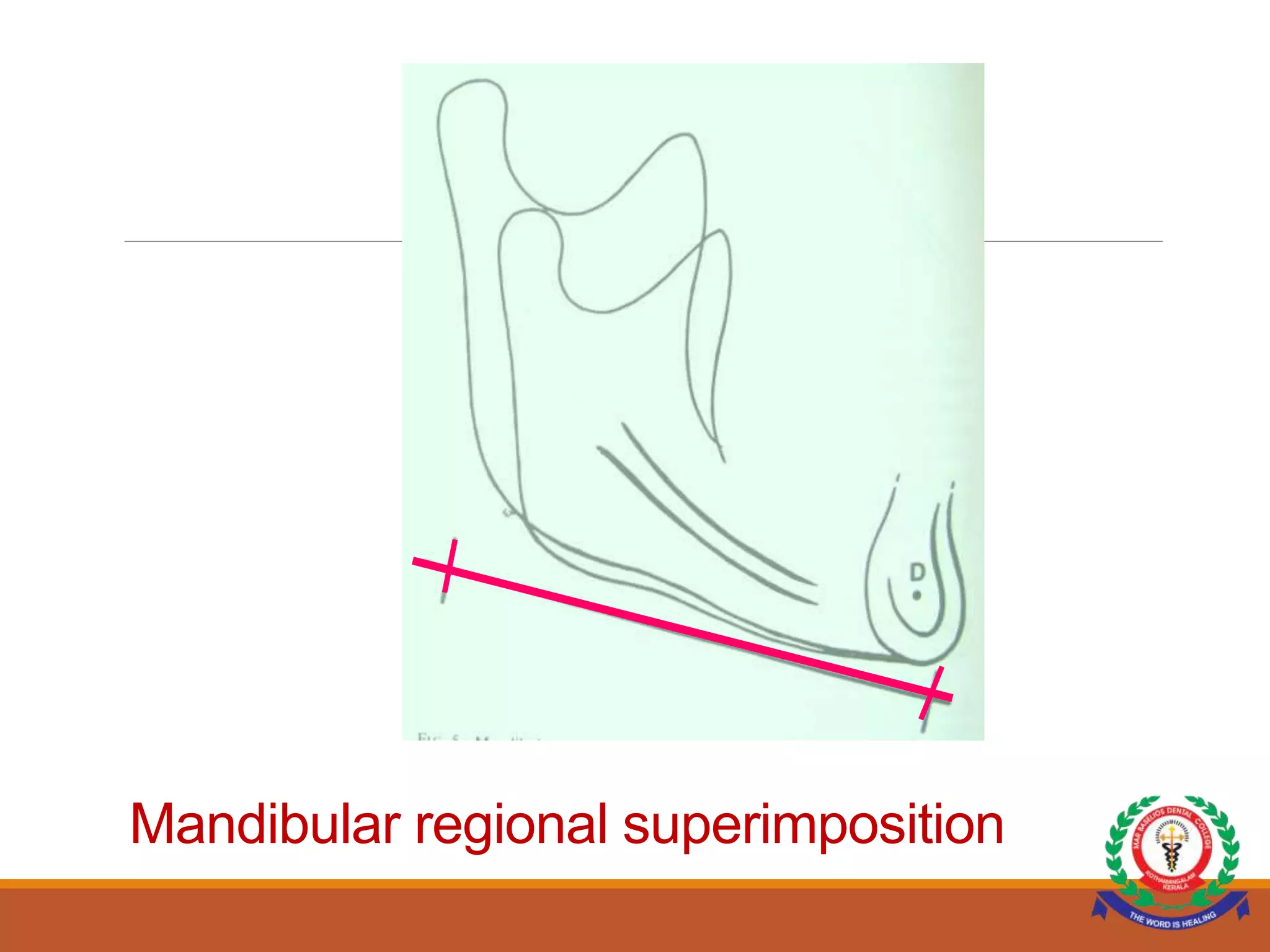 CEPHALOMETRIC SUPERIMPOSITION.ppt