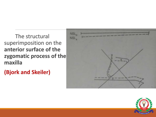 CEPHALOMETRIC SUPERIMPOSITION.ppt | Dental Health | Diseases and Conditions