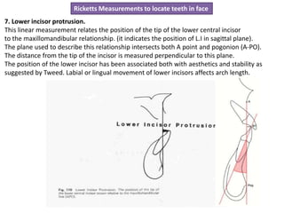 4 . McNamara analysis; Skeletal study; Maxillary Length (also called midfacial length)
It measures the distance from condy...