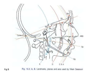 Ricketts Analysis (1960s)
Ricketts analysis essentialy tries to orient
face and mandible to the cranium.
Ricketts tries to...