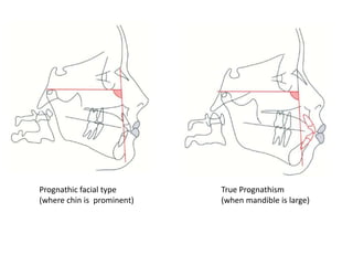 Prognathic facial type
(where chin is prominent)

True Prognathism
(when mandible is large)

 
