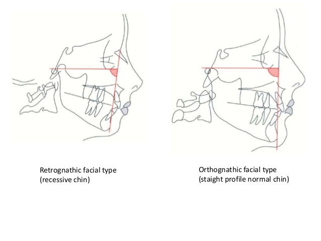 cephalometric analysis cephalometric analysis