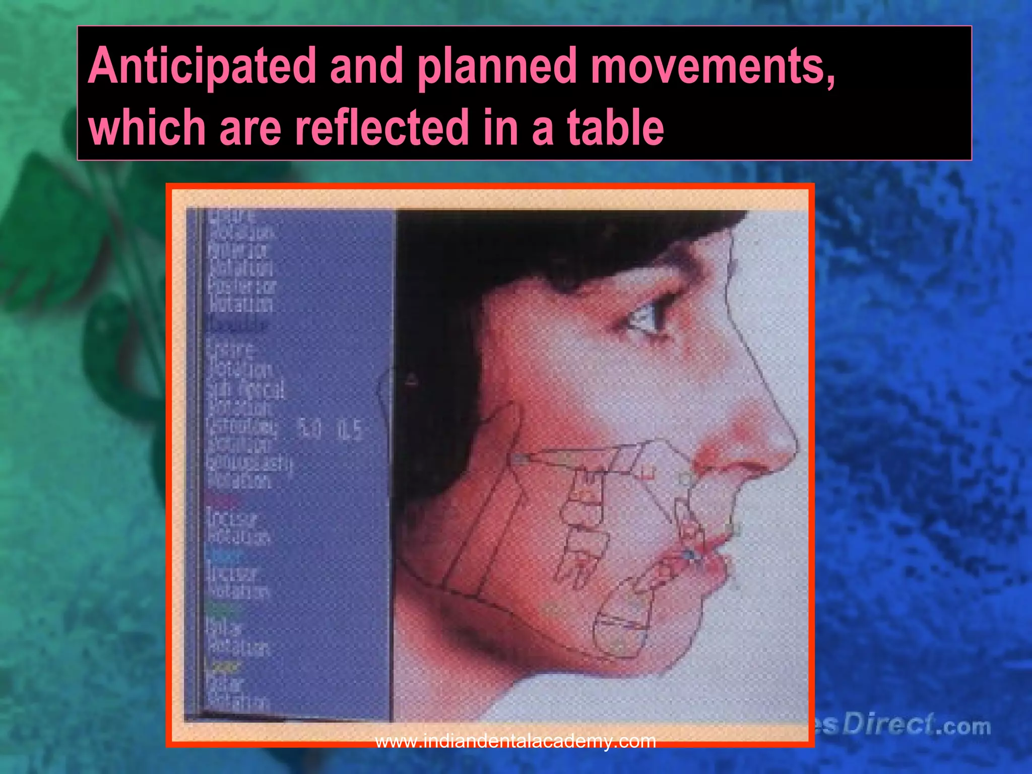 Anticipated and planned movements,
which are reflected in a table
www.indiandentalacademy.com
 