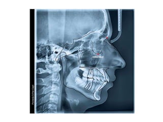 Lateral cephalogram (Orthodontics) | PPTX