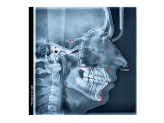 Lateral cephalogram (Orthodontics)