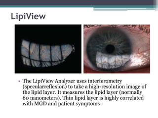LipiView




 • The LipiView Analyzer uses interferometry
   (specularreflexion) to take a high-resolution image of
   the lipid layer. It measures the lipid layer (normally
   60 nanometers). Thin lipid layer is highly correlated
   with MGD and patient symptoms
 