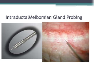 IntraductalMeibomian Gland Probing
 