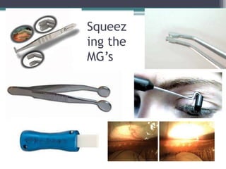 Squeez
ing the
MG’s
 