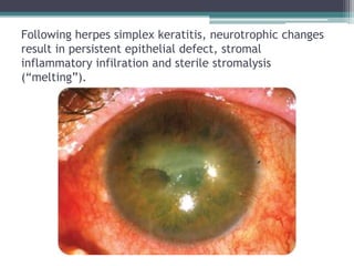 Following herpes simplex keratitis, neurotrophic changes
result in persistent epithelial defect, stromal
inflammatory infilration and sterile stromalysis
(“melting”).
 