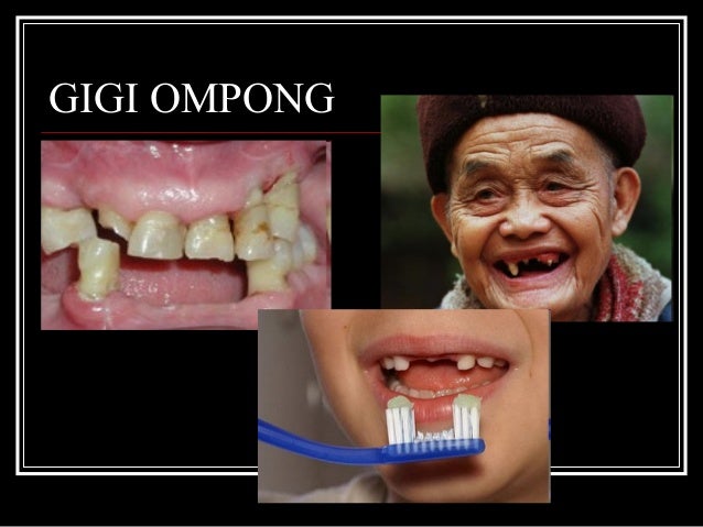 Hasil gambar untuk gambar karies gigi lansia