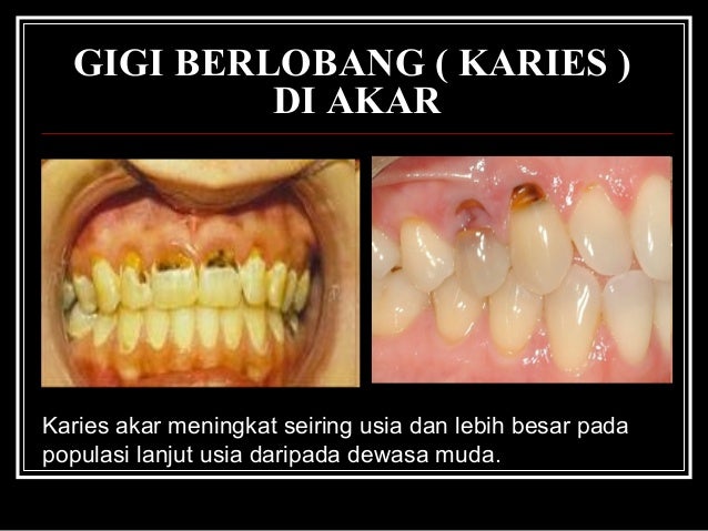 Ceramah gigi  lansia 