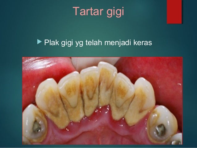 Ubat Gigi Untuk Masalah Gusi - Contoh L