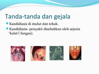 Tanda-tanda dan gejala
Kandidiasis di mulut dan tekak.
Kandidiasis- penyakit disebabkan oleh sejenis

‘kulat’( fungus).

 