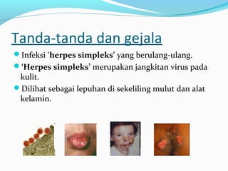 Tanda-tanda dan gejala
Infeksi ‘herpes simpleks’ yang berulang-ulang.
‘Herpes simpleks’ merupakan jangkitan virus pada

kulit.
Dilihat sebagai lepuhan di sekeliling mulut dan alat
kelamin.

 