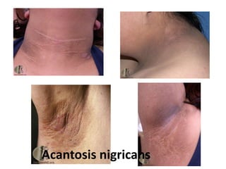 Acantosis nigricans
 