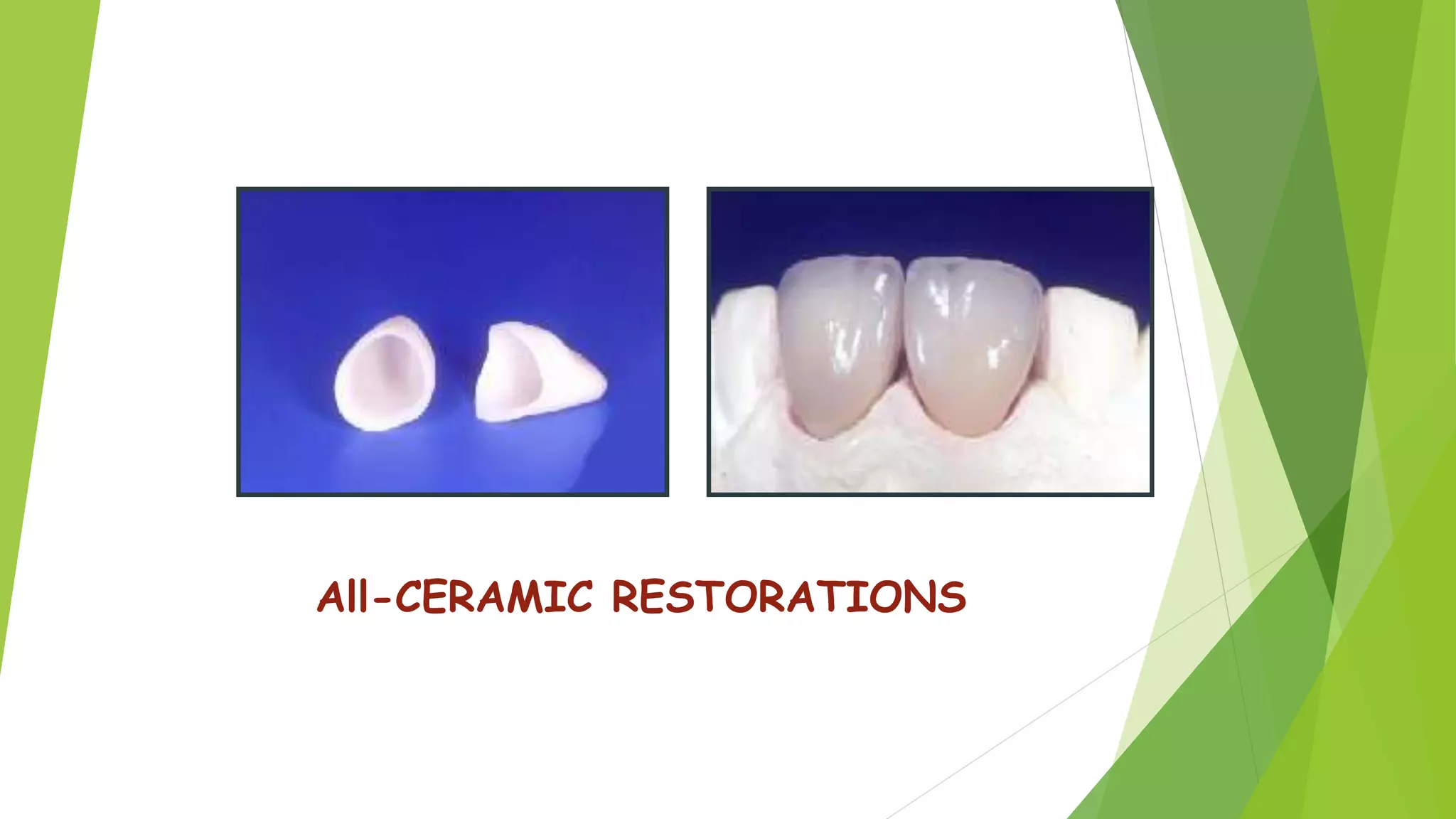 Dental Ceramics and Porcelain fused to metal | PPTX