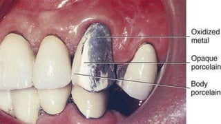 Dental Ceramics and Porcelain fused to metal | PPTX