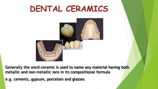 Dental Ceramics and Porcelain fused to metal | PPTX