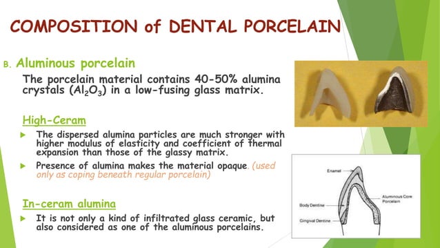 Dental Ceramics and Porcelain fused to metal | PPTX