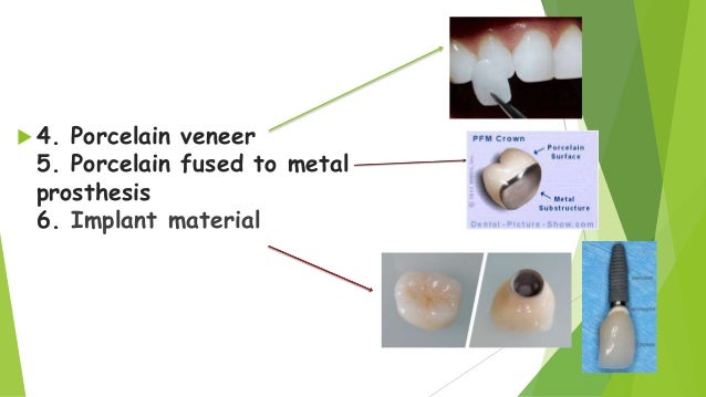 Dental Veneer
