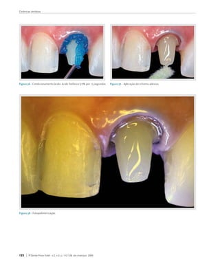 Cerâmicas dentárias




Figura 36 - Condicionamento	ácido:	ácido	fosfórico	37%	por	15	segundos.    Figura 37 - Aplicação	do	sistema	adesivo.




Figura 38 - Fotopolimerização.




122     R Dental Press Estét - v.2, n.2, p. 112-128, abr./maio/jun. 2005
 