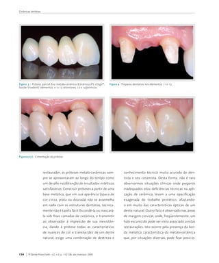 Cerâmicas dentárias




Figura 3 - Prótese	 parcial	 fixa	 metalo-cerâmica	 (Cerâmica	 IPS	 d.Sign®,	   Figura 4 - Preparos	dentários	nos	elementos	11	e	13.
Ivoclar	Vivadent):	elementos	11	e	13	retentores,	12	e	14	ponticos.




Figura 5 e 6 - Cimentação	da	prótese.




                      restaurador,	as	próteses	metalo-cerâmicas	sem-                       conhecimento	 técnico	 muito	 acurado	 do	 den-
                      pre	se	apresentaram	ao	longo	do	tempo	como	                          tista	 e	 seu	 ceramista.	 Desta	 forma,	 não	 é	 raro	
                      um	desafio	na	obtenção	de	resultados	estéticos	                      observarmos	 situações	 clínicas	 onde	 preparos	
                      satisfatórios.	Construir	próteses	a	partir	de	uma	                   inadequados	e/ou	deficiências	técnicas	na	apli-
                      base	metálica,	que	em	sua	aparência	(opaca	de	                       cação	 da	 cerâmica,	 levam	 a	 uma	 opacificação	
                      cor	 cinza,	 prata	 ou	 dourada)	 não	 se	 assemelha	                exagerada	 do	 trabalho	 protético,	 afastando-
                      em	 nada	 com	 as	 estruturas	 dentárias,	 tecnica-                  o	 em	 muito	 das	 características	 ópticas	 de	 um	
                      mente	não	é	tarefa	fácil.	Escondê-la	ou	mascará-                     dente	natural.	Outro	fato	é	observado	nas	áreas	
                      la	 sob	 finas	 camadas	 de	 cerâmica,	 e	 transmitir	               de	margem	cervical,	onde,	freqüentemente,	um	
                      ao	 observador	 à	 impressão	 de	 sua	 inexistên-                    halo	escurecido	pode	ser	visto	associado	a	estas	
                      cia,	 dando	 à	 prótese	 todas	 as	 características	                 restaurações.	Isto	ocorre	pela	presença	da	bor-
                      de	nuances	de	cor	e	translucidez	de	um	dente	                        da	 metálica	 característica	 da	 metalo-cerâmica	
                      natural,	 exige	 uma	 combinação	 de	 destreza	 e	                   que,	 por	 situações	 diversas,	 pode	 ficar	 posicio-



114     R Dental Press Estét - v.2, n.2, p. 112-128, abr./maio/jun. 2005
 