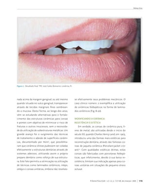 Sidney Kina




Figura 7 - Resultado	final.	TPD.	José	Carlos	Romanini,	Londrina,	Pr.




nada	acima	da	margem	gengival,	ou	até	mesmo	                           se	 efetivamente	 seus	 problemas	 mecânicos.	 O	
quando	situada	no	sulco	gengival,	transparecer	                        caso	 clínico	 número	 2	 exemplifica	 a	 utilização	
através	 de	 tecidos	 marginais	 finos	 sombrean-                      de	 cerâmicas	 feldspáticas	 na	 forma	 de	 lamina-
do	 a	 mucosa.	 Desta	 forma,	 ao	 longo	 dos	 anos,	                  dos	cerâmicos	(Fig.	8-20).	
vêm	 se	 estudando	 alternativas	 para	 o	 fortale-
cimento	 das	 estruturas	 cerâmicas	 para	 coroas	                     modIFIcando a ceRâmIca:
e	pontes	com	objetivo	de	minimizar	o	risco	de	                         ReSIStêncIa e eStétIca
fraturas	 e	 outros	 insucessos,	 sem	 a	 necessida-                      Em	 verdade,	 as	 coroas	 de	 cerâmica	 pura,	 li-
de	da	utilização	de	subestruturas	metálicas.	Um	                       vres	 de	 metal,	 são	 utilizadas	 desde	 o	 início	 do	
grande	 avanço	 foi	 o	 surgimento	 das	 técnicas	                     século	XX,	quando	Charles	Henry	Land,	em	1903,	
de	tratamento	e	adesão	de	superfícies	cerâmi-                          introduziu	uma	das	formas	mais	estéticas	para	
cas,	 documentado	 por	 Horn ,	 que	 possibilita-
                                      5
                                                                       reconstrução	dentária,	através	das	famosas	co-
ram	que	cerâmica	vítreas	pudessem	ser	coladas	                         roas	de	jaqueta	cerâmica	(Porcelain-jacket	cro-
efetivamente	a	estruturas	dentárias	através	de	                        wn)13.	 Com	 qualidades	 estéticas	 ótimas,	 estas	
sistemas	 adesivos,	 utilizando	 assim	 o	 próprio	                    coroas	 são	 fabricadas	 com	 porcelanas	 feldspá-
preparo	dentário	como	reforço	de	sua	estrutu-                          ticas,	 que	 infelizmente,	 devido	 à	 sua	 baixa	 re-
ra.	Este	fato	permitiu	a	otimização	na	utilização	                     sistência,	limitam	sua	indicação	apenas	para	co-
de	 técnicas	 como	 laminados	 cerâmicos,	 inlays,                     roas	 unitárias	 em	 situações	 de	 pequeno	 stress	
onlays	e	coroas	unitárias,	embora	não	resolves-                        oclusal.	



                                                                                       R Dental Press Estét - v.2, n.2, p. 112-128, abr./maio/jun. 2005   115
 