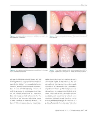 Sidney Kina




Figura 12 - Laminado	cerâmico	do	elemento	12.	Observe	no	detalhe	sua	      Figura 13 - Preparo	dentário	do	elemento	12.	Observe	o	término	cervical	
fina	espessura	e	translucidez.                                             supra	gengival.




Figura 14 - Laminado	seco	sobre	o	preparo	dentário.	Observe	a	diferença	   Figura 15 - Prova	do	laminado	através	de	pasta	matizada	(Variolink	II	Try	
de	cor	entre	dente	e	laminado.                                             In,	Ivoclar	Vivadent),	para	correção	da	cor	através	da	cimentação	adesiva.




poração	 de	 óxido	 de	 alumínio	 evidenciava	 me-                 flexão	quatro	vezes	mais	alta	que	uma	cerâmica	
lhora	 significativa	 nas	 propriedades	 mecânicas	                aluminizada	 a	 50%,	 muito	 embora,	 a	 alta	 con-
da	cerâmica.	Sadoun 	começou	a	trabalhar	com	
                         14
                                                                   centração	 de	 alumina	 acarrete	 em	 diminuição	
munhões	 aluminizados	 infiltrados	 por	 vidro,	 à	                significativa	 da	 translucidez	 com	 conseqüente	
base	de	óxido	de	lantânio	(La2O3),	com	cerca	de	                   empobrecimento	das	qualidades	ópticas	da	ce-
97%	de	agregação	de	óxidos	de	alumínio,	crian-                     râmica.	Desta	forma,	este	material	não	deve	ser	
do	 um	 sistema	 cerâmico	 de	 alta	 resistência.	                 usado	 como	 uma	 cerâmica	 de	 cobertura,	 mas,	
Este	sistema,	apresentado	pela	companhia	Vita	                     devido	à	sua	alta	resistência,	ser	aplicado	como	
(Zahnfabrik,	 Bad	 Sackingen,	 Alemanha)	 recebe	                  substituto	das	subestruturas	metálicas.	Esta	si-
o	nome	comercial	de	In-Ceram®	Alumina.	O	In-                       tuação,	permite	a	construção	de	coroas	totais	e	
Ceram®	 Alumina	 apresenta	 uma	 resistência	 à	                   próteses	fixas	de	três	elementos	(até	2o	pré-molar)	



                                                                                     R Dental Press Estét - v.2, n.2, p. 112-128, abr./maio/jun. 2005   117
 