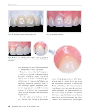 Cerâmicas dentárias




Figura 16 - Laminados	cerâmicos	sobre	o	modelo	rígido.                              Figura 17 - Laminados	cimentados.




Figura 18, 19, 20 - Caso	 finalizado.	 Observe	 na	 fig.	 21	 o	 close-up	 da	 região	 de	
união	cervical	entre	laminado	cerâmico	e	estrutura	dentária.	TPD.	Paulo	Kano,	
São	Paulo,	SP.




                      livres	de	metal.	O	caso	clínico	número	3	exemplifi-
                      ca	a	utilização	deste	sistema	(Fig.	21	a	24).
                          Baseado	no	mesmo	sistema,	a	Vita	apresen-
                      ta	ainda	no	mercado	duas	variações	do	sistema	
                      In-Ceram®:	 o	 In-Ceram®	 Spinell,	 que	 agrega	
                      além	do	óxido	de	alumínio	o	óxido	de	magné-                              mente	 69%	 de	 óxido	 de	 alumina	 (Al2O3)	 com	
                      sio	 (aluminato	 de	 magnésio,	 MgAl2O4),	 o	 que	                       31%	 de	 óxido	 de	 zircônio	 (ZrO2),	 que	 resulta	
                      lhe	confere	o	dobro	de	translucidez	do	In-Ce-                            em	 um	 aumento	 significativo	 da	 resistência	 à	
                      ram®.	Entretanto,	o	ganho	em	padrões	estéti-                             flexão,	 conferindo	 um	 dos	 maiores	 valores	 de	
                      cos	tem	seu	preço,	com	a	perda	de	resistência	                           tenacidade	entre	os	materiais	cerâmicos.	Nova-
                      na	ordem	de	20%,	limita	suas	indicações	para	                            mente	observamos	aqui	uma	considerável	me-
                      coroas	unitárias	anteriores,	facetas	laminadas,	                         lhora	nas	condições	de	resistência	mecânica	em	
                      inlays	e	onlays .	    1
                                                                                               detrimento	das	qualidades	ópticas,	conduzindo	
                          Por	 outro	 lado,	 o	 sistema	 oferece	 o	 In-Ce-                    a	um	sistema	sensivelmente	opaco.	Suas	indica-
                      ram®	 Zircônia,	 uma	 mistura	 de	 aproximada-                           ções	mais	precisas	limitaram-se,	portanto,	para	



118     R Dental Press Estét - v.2, n.2, p. 112-128, abr./maio/jun. 2005
 