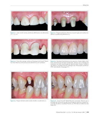 Sidney Kina




Figura 21 - Caso	 inicial.	 Coroas	 protéticas	 defeituosas	 nos	 elementos,	   Figura 22 - Preparos	dentários.	Observe	a	reconstrução	com	núcleos	me-
12,	11,	21,	22.                                                                 tálicos	e	a	ausência	do	elemento	22.




Figura 23 - Prova	dos	copings	cerâmicos	(Copings	de	In-Ceram®	Alumi-            Figura 24 - Resultado	final	(Cerâmica	de	cobertura:	Vitadur	Alpha,	Vita).	
na,	Vita).	Observe	a	infra-estrutura	do	elemento	22	em	cantilever.              Com	 características	 de	 baixa	 translucidez,	 observe	 que	 o	 emprego	 de	
                                                                                cerâmicas	com	alta	concentração	de	alumina	sobre	núcleos	metálicos	
                                                                                não	 altera	 o	 resultado	 final	 da	 coloração	 das	 restaurações	 protéticas.	
                                                                                (TPD.	João	Salvador,	Arapongas,	Pr.).




Figura 25 - Preparo	dentário	sobre	núcleo	metálico	no	elemento	12.              Figura 26 - Coroa	 Procera®	 (Nobel	 Biocare)	 cimentada.	 Observe	 que	 a	
                                                                                exemplo	das	estruturas	de	alta	concentração	de	alumina	o	preparo	es-
                                                                                curecido	não	altera	o	resultado	final	de	cor.	(TPD.	Marcos	Celestrino,	São	
                                                                                Paulo,	SP.).




                                                                                           R Dental Press Estét - v.2, n.2, p. 112-128, abr./maio/jun. 2005   119
 