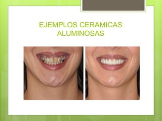 EJEMPLOS CERAMICAS
ALUMINOSAS
 