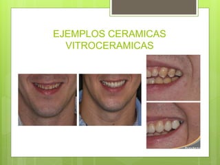 EJEMPLOS CERAMICAS
VITROCERAMICAS
 