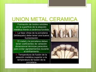 UNION METAL CERAMICA
 