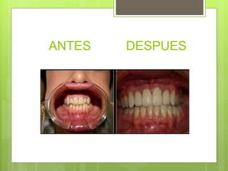 ANTES DESPUES
 