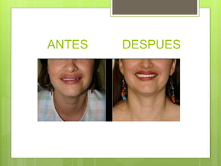 ANTES DESPUES
 