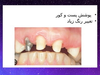 •
‫کور‬ ‫و‬ ‫پست‬ ‫پوشش‬
•
‫زیاد‬ ‫رنگ‬ ‫تغییر‬
 