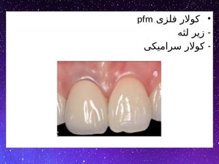 •
‫فلزی‬ ‫کوالر‬
pfm
-
‫لثه‬ ‫زیر‬
-
‫سرامیکی‬ ‫کوالر‬
 