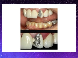 ceramicc (1).pptx for Dentistry students