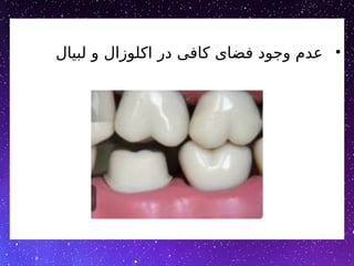 •
‫لبیال‬ ‫و‬ ‫اکلوزال‬ ‫در‬ ‫کافی‬ ‫فضای‬ ‫وجود‬ ‫عدم‬
 