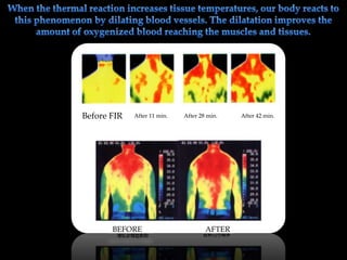 Before FIR After 11 min. After 28 min. After 42 min.
BEFORE AFTER
 